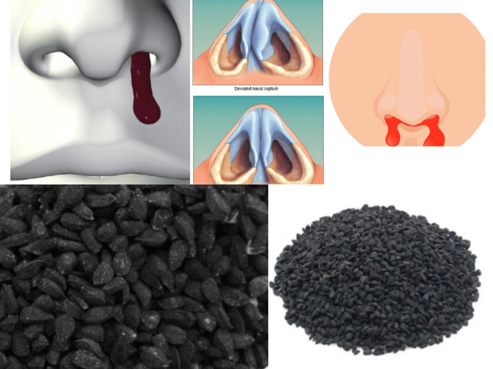 Nasal Diseases and Their Management
