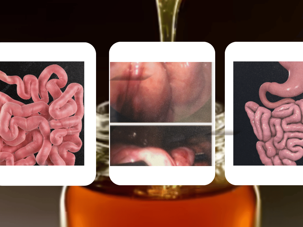 Honey and intestine treatment with honey