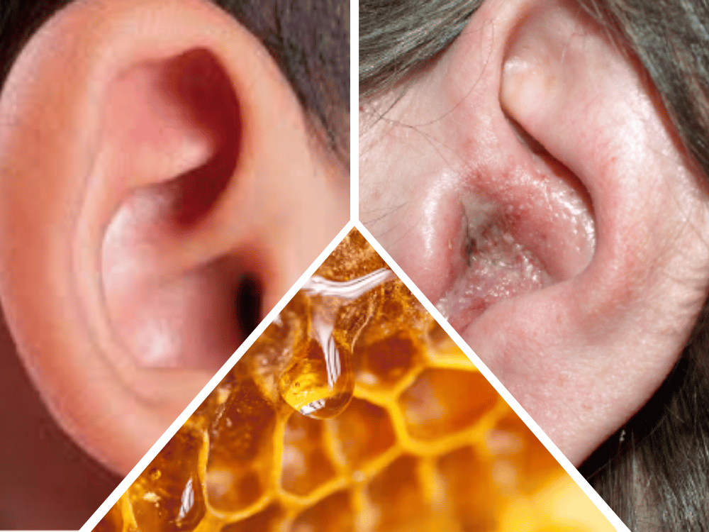 Honey and Its Functions (Ear Health) Honey and Its Functions (Ear Health)